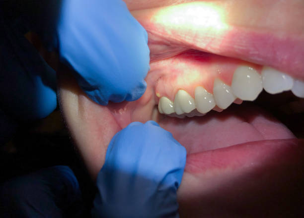 Best Emergency Tooth Extraction in New Knoxville, OH